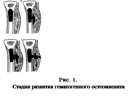 Фазы остеомиелита. Патогенез гематогенного остеомиелита. Патогенез острого остеомиелита. Стадии гематогенного остеомиелита. Классификация остеомиелита у детей.